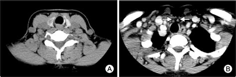 Contrast Enhanced Neck Ct Scan Shows Irregularly Margined And