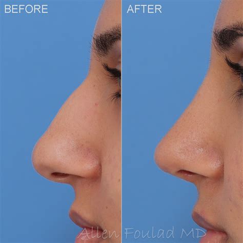 Septoplasty And Turbinate Reduction Before And After