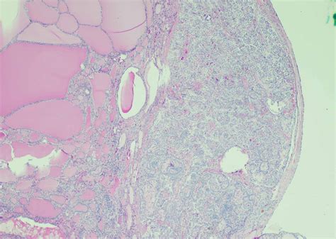 Cureus Papillary Thyroid Carcinoma In Struma Ovarii