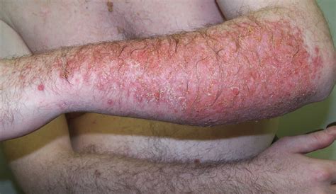 Allergic Contact Dermatitis Causes Symptoms Diagnosis Treatment