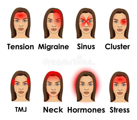 Set Of Headache Types On Different Area Of Patient Head Woman With