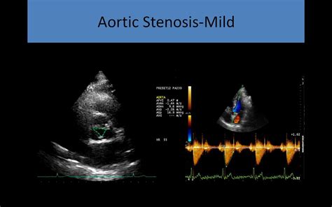 Aortic Stenosis Echo Doppler