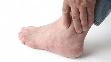 How To Recognize Gout Symptoms Foot Care Youtube