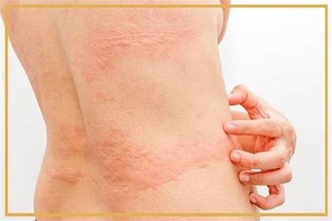 Urticaria Treatment Services At Best Price In Gurgaon Id 17029829291