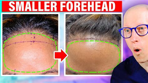 How To Fix A Large Forehead Forehead Reduction Youtube