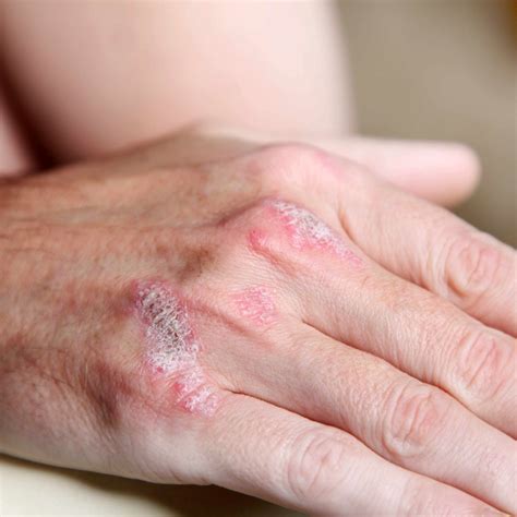 Mayo Clinic Q And A Psoriasis A Chronic Condition But Treatment Can