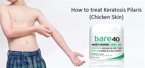 How To Treat Keratosis Pilaris Or Chicken Skin With Urea Gel