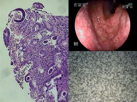 Infection And Hyperinfection With Strongyloides Stercoralis Clinical