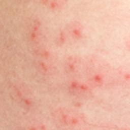 All dermatologists in spain were asked to share details of covid patients they had seen who had developed rashes in the previous two weeks. Skin rash: 68 pictures, causes, and treatments