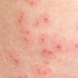 Skin rash: 68 pictures, causes, and treatments