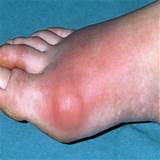 Medical Condition Gout