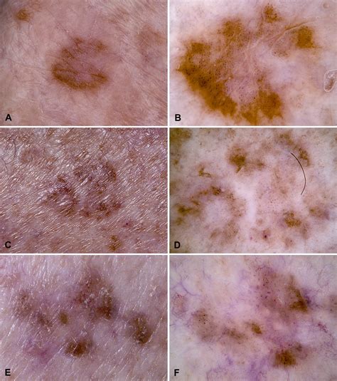 Dermatoscopy Of Pigmented Bowens Disease Journal Of The American