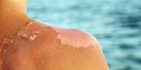 Sunburn Peeling Causes Plus Skin Remedies To Heal Faster