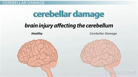 Cerebellar Damage Symptoms And Treatment Lesson