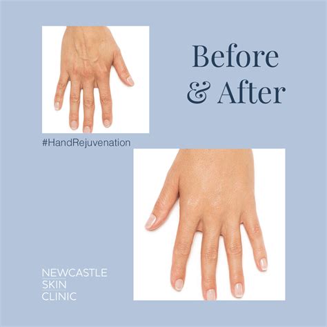 Hand Rejuvenation Newcastle Skin Clinic