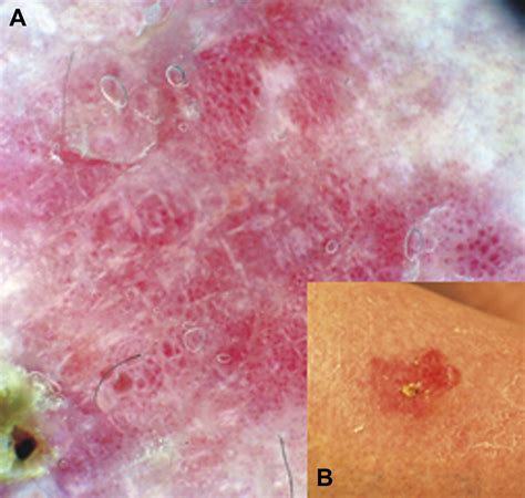 Dermatoscopic Vascular Patterns In Cutaneous Merkel Cell Carcinoma