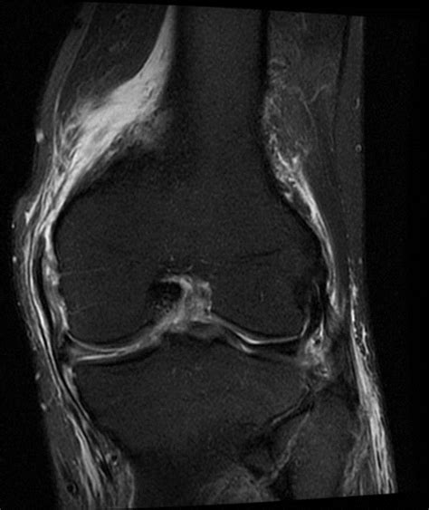 View of the anatomical labels. Medial Supporting Structures of the Knee with Emphasis on ...