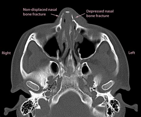 This video looks at the nasal bones; Broken Nose Repair | Rhinoplasty in Seattle | Rhinoplasty ...