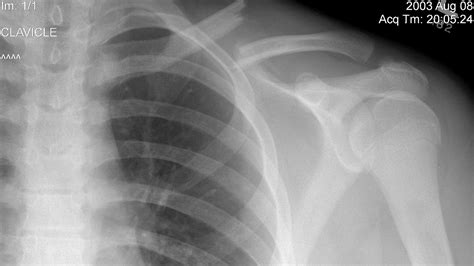 Collar Bone Injuries Injury Injury Choices