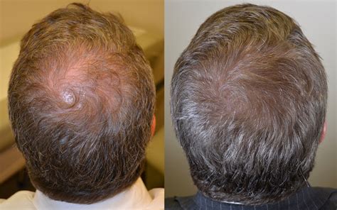 By inhibiting this process, areas of the scalp that are notorious for male pattern. Propecia before and after photos - Dr Rogers - New Orleans
