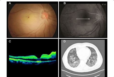 A Retinography Of The Right Eye Shows Diffuse Retinal Paleness With A