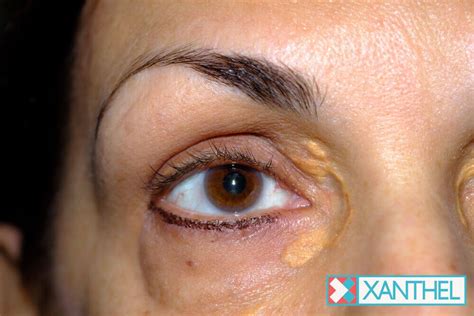Eyelid Xanthomas Xanthelasma Treatment