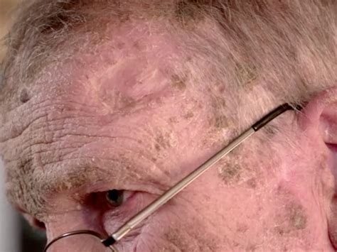 Dr Pimple Popper Treated A Man With Intensely Painful Scaly Skin And