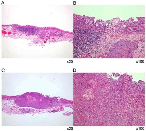 Histological Examination Of The Endoscopically Resected Specimen A