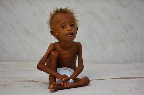 A Child In Yemen Dies Of Malnutrition Every 10 Minutes According To