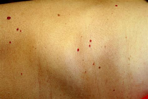 Cherry Angioma Pictures Cherry Angiomas Finesse Skin Clinic In