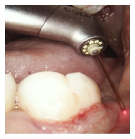 A Initial Probing Depth Of Mm B Subgingival Root Surface