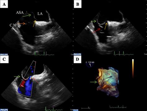 Transoesophageal Echocardiography Bicaval View Of A Patient With A