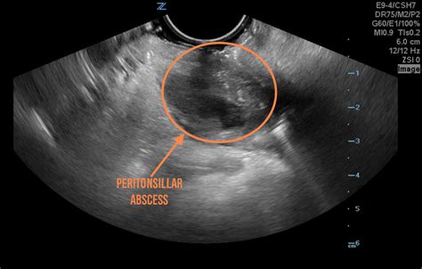 Hennepin Ultrasound Peritonsillar Abscess Drainage