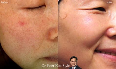 Laser Capillary Removal Dr Peter Kim Surgery Skin Cancer Cosmetic