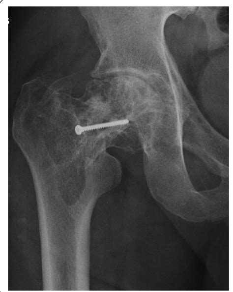 AP radiograph of the right hip showing a basicervical ...