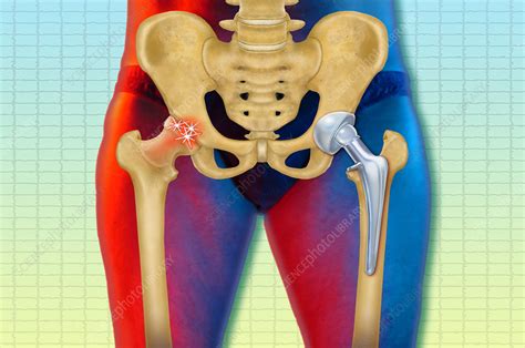 Replacement Hip Illustration Stock Image C0276507 Science Photo