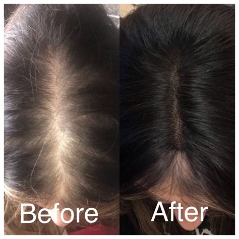 Our integration systems last roughly 1 year with the correct use of our recommended hair extension aftercare kit. Hair Extensions / Hair Loss Systems - Slice Hairdressers