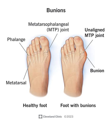 Bunions Symptoms Causes And Treatment