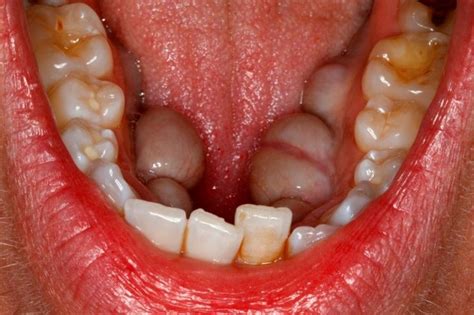 Tori Mandibular Dental With Images Dental Hygiene School Dental