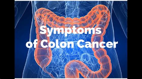 8 Early Warning Signs Of Colon Cancer Youtube