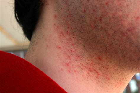 How To Treat A Shaving Rash Burn In One Day How To Fix And Repair