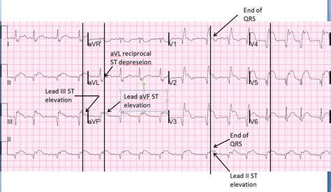 There are five basic acute mi ecg patterns you will encounter. Dr. Smith's ECG Blog: Large Transmural STEMI with ...