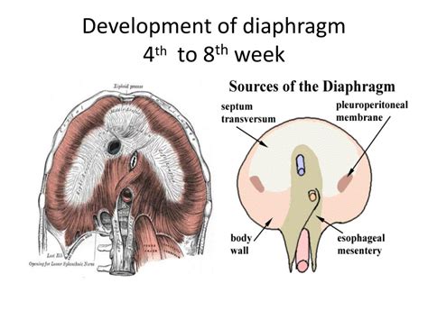 Ppt Congenital Diaphragmatic Hernia C D H Powerpoint Presentation