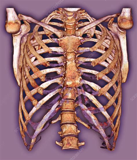 The enclosed area created by and within the ribs. Rib cage, 3D CT scan - Stock Image - P116/0655 - Science Photo Library