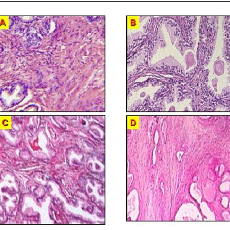The Incidence Of Both Histological Benign Prostatic Hyperplasia Bph Download Scientific