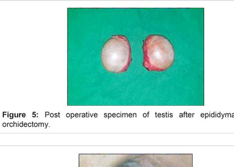 Epididymal Sparing Bilateral Orchidectomy With Epididymoplasty For