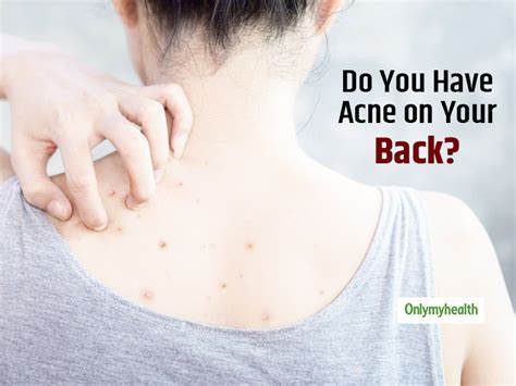 Acne On The Back Is Common Know Back Acne Causes Treatment And