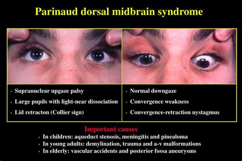 Eye movements, coma and pseudocoma. PPT - SUPRANUCLEAR DISORDERS OF EYE MOVEMENT PowerPoint ...