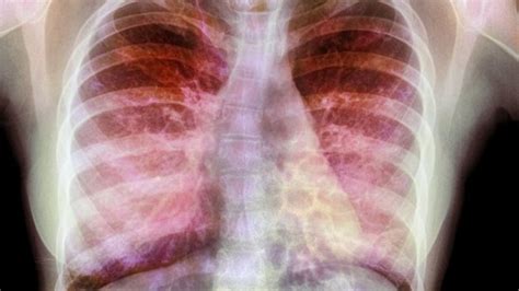 Gene Therapy Stabilises Lungs Of Cystic Fibrosis Patients Bbc News