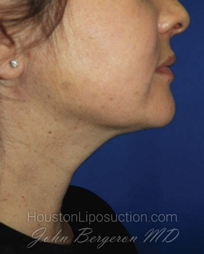 Patient 2799 Liposuction Before And After Photos Katy Cosmetic